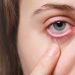 Conjunctivitis: No need to panic, will clear off in 1-2 weeks