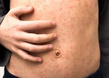 Government preparing to launch vaccination drive for measles across country