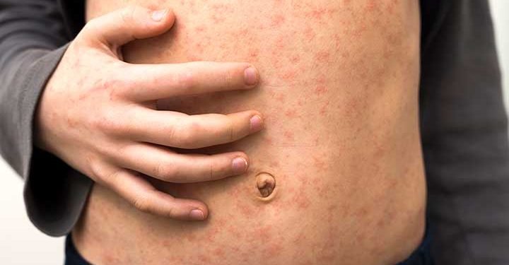 Government preparing to launch vaccination drive for measles across country