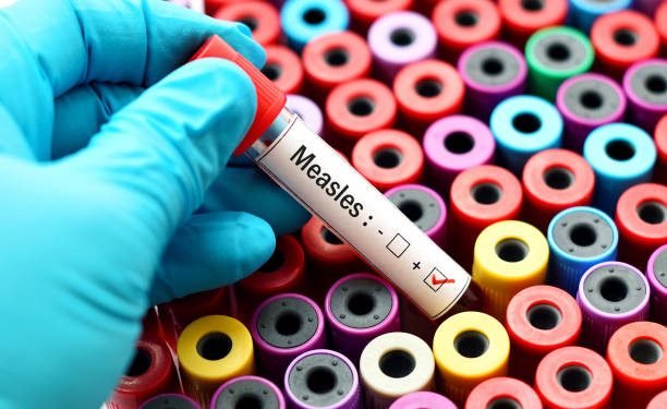 Measles cases detected in Jhapa