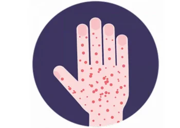 Measles outbreak in Dhorpatan under control