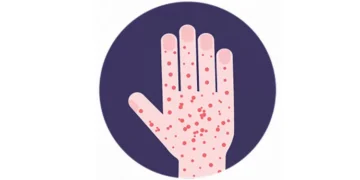 Measles outbreak in Dhorpatan under control